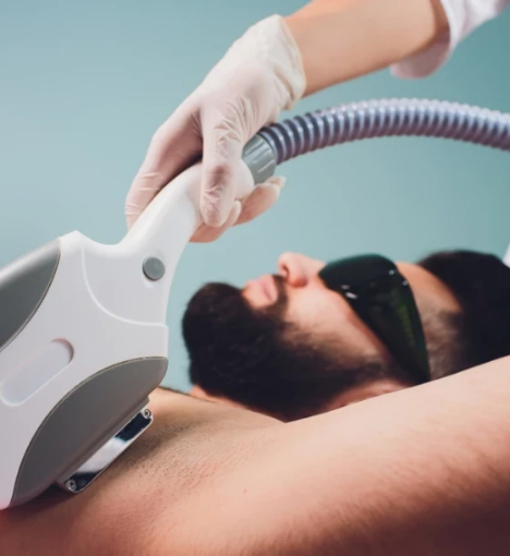 صورة جلسة ليزر لإزالة الشعر للجسم الكامل (استثناء الظهر والبطن) – للرجال