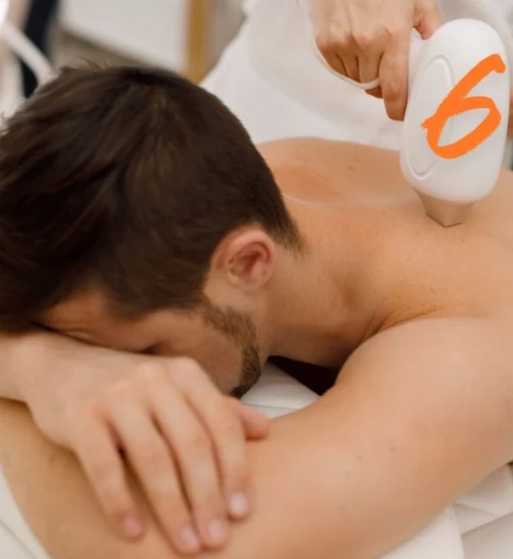 صورة ستة جلسات ليزر إزالة الشعر للجسم الكامل - للرجال