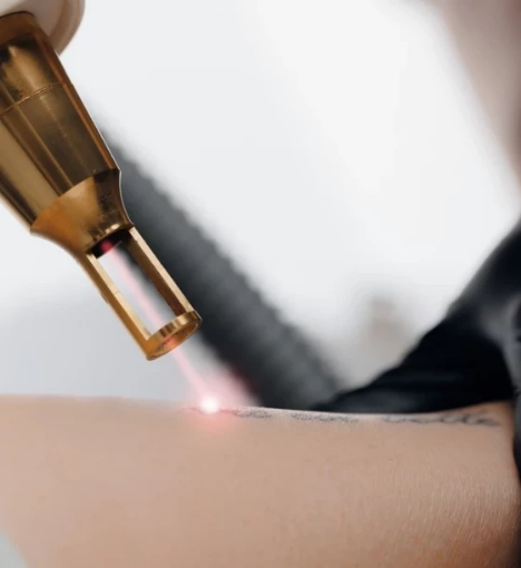 صورة جلسة إزالة التاتو بالليزر