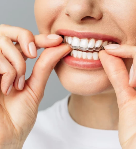 صورة تبييض الأسنان بالقوالب المنزلية