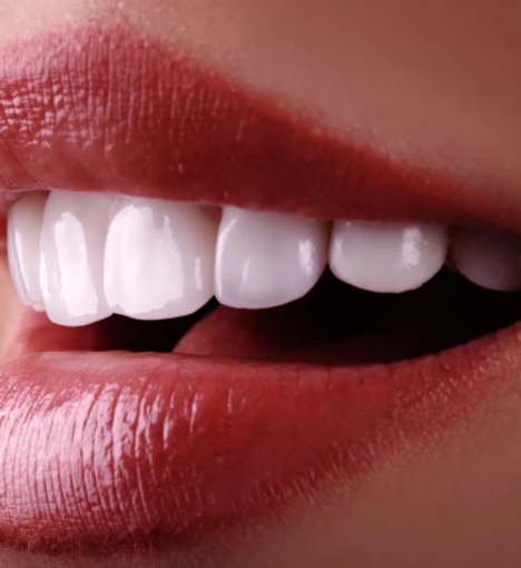 صورة تركيبات الزيركون- ابتسامة طبيعية تدوم طويلاً