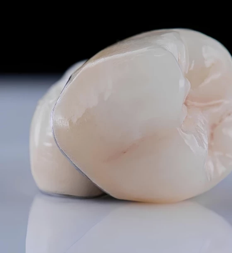 صورة تركيبات البورسلين- ابتسامة مثالية تدوم طويلاً