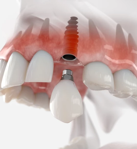 صورة زراعة الأسنان + تركيب الزيركون