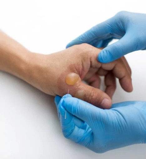 صورة العناية بالحروق من الدرجة الثانية