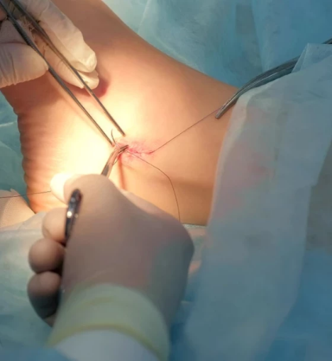 صورة خدمة إزالة الخيوط الجراحية في المنزل – رعاية ما بعد الجراحة