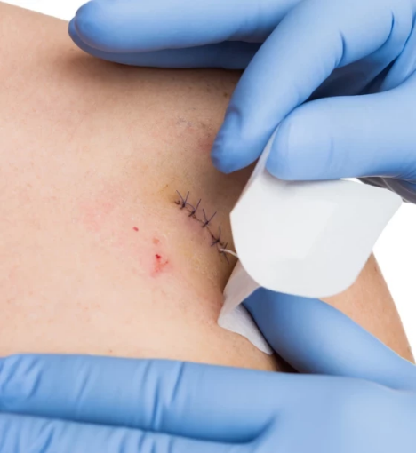 صورة خدمة إزالة الغرز  في المنزل