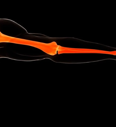 صورة تصحيح كسر العظام العلوي بدون زراعة معدنية