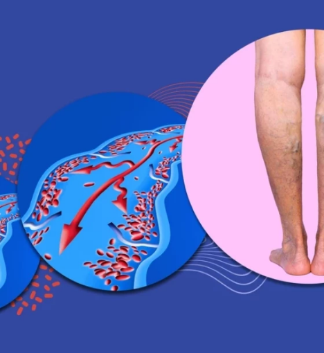 صورة عملية ربط الأوردة المتعددة لعلاج دوالي الساق