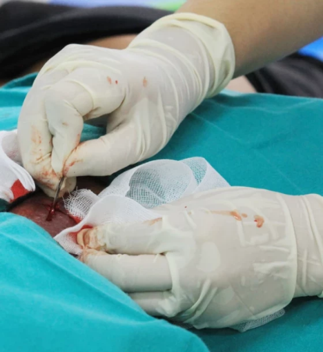 صورة عملية شق وتصريف خراج كبير تحت التخدير العام