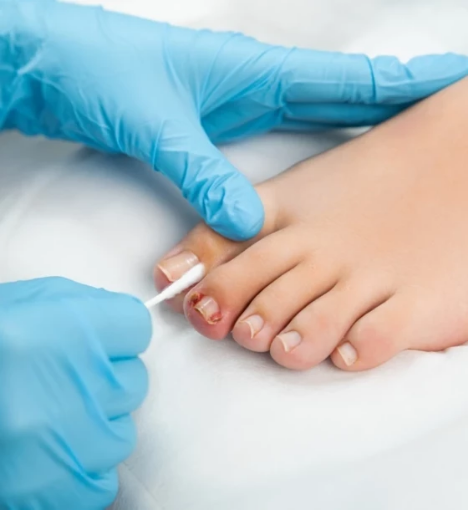 صورة عملية زاديك لعلاج الظفر الغائر