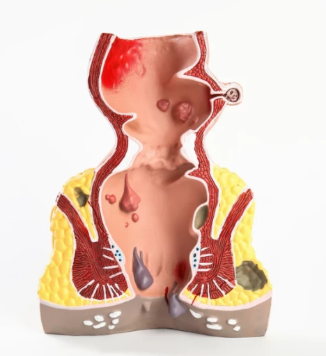 صورة عملية شق وتصريف الخراج الشرجي الكبير تحت التخدير العام