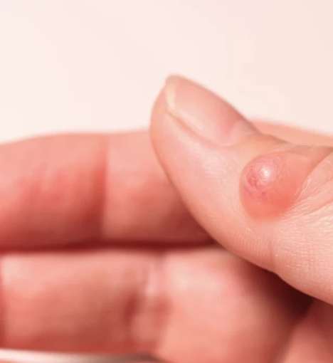 صورة عملية استئصال الكيس العقدي أو الورم الشحمي