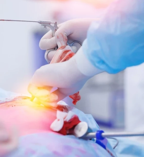 صورة عملية استئصال المرارة بالمنظار