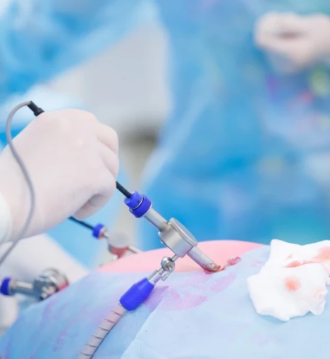 صورة عملية استئصال المرارة بالجراحة المفتوحة