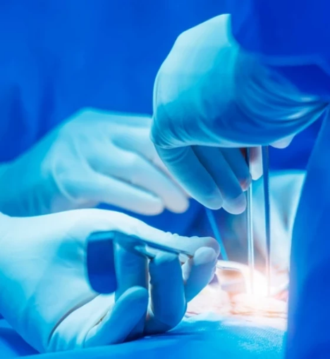 صورة عملية استئصال الناسور الشرجي المرتفع (High Perianal Fistulectomy)