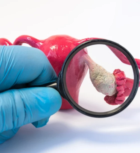 صورة عملية استئصال كيس المبيض البسيط