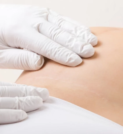 صورة جلسات التعافي بعد الولادة القيصرية: برنامج لتقوية الجسم واستعادة الحركة