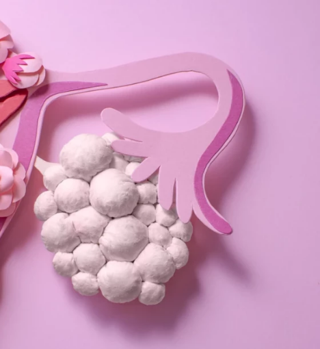 صورة باقة فحص تكيس المبايض