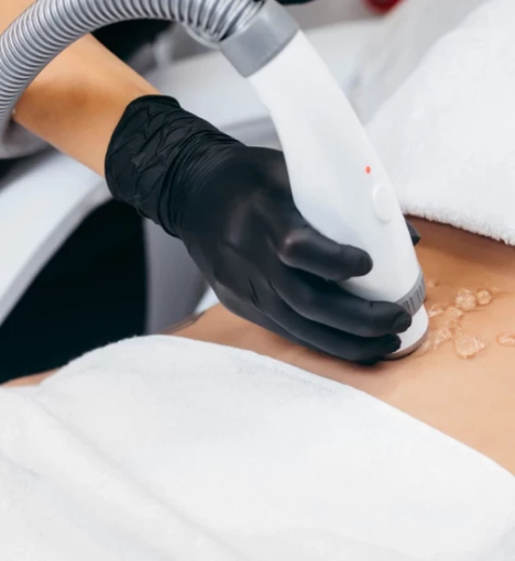 صورة باقة إزالة الشعر بالليزر للجسم الكامل مع الوجه - 12 جلسة لمدة سنة + رتوش